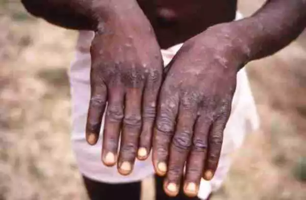 A MUST READ – Here Are The Seven Things To Do To Avoid Monkeypox